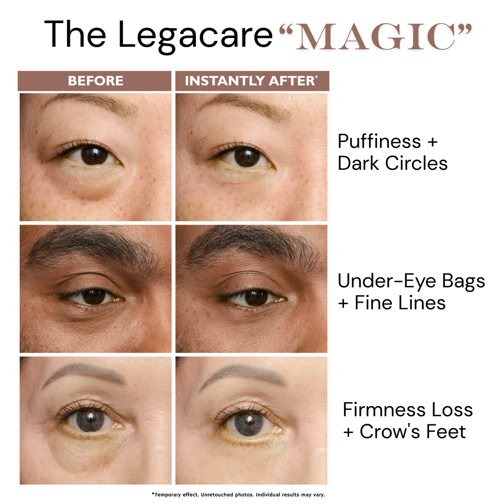 Temporary Eye Tightener